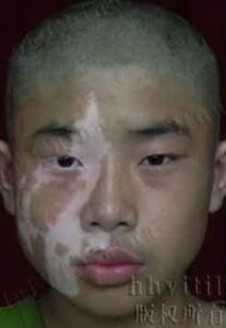 rhésus négatif origine sang neanderthal